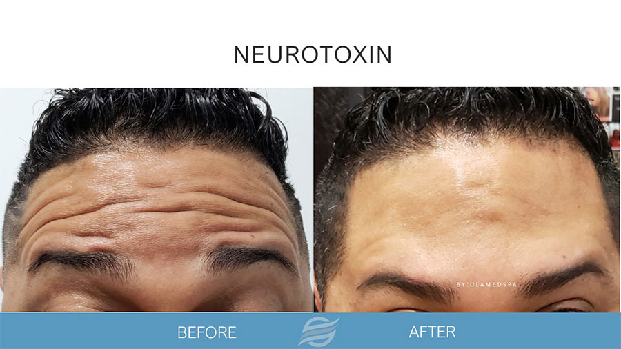 Botox treatment result