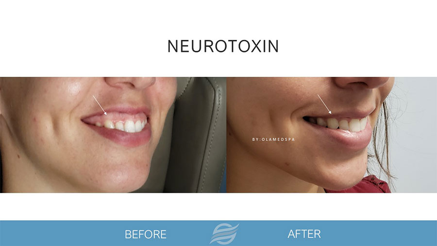 Dysport treatment result