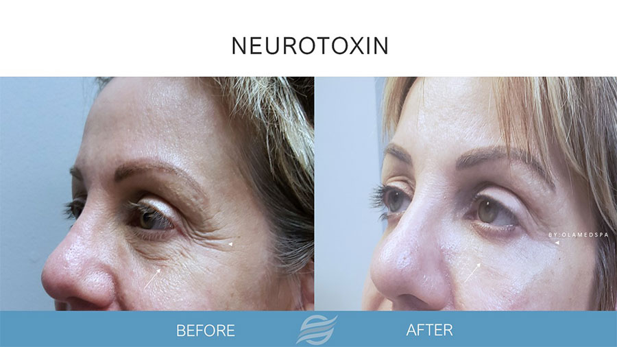 Neuromodulator before and after