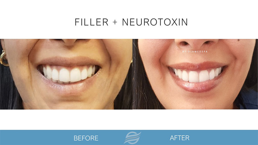 Botox before and after results at Olam Med Spa