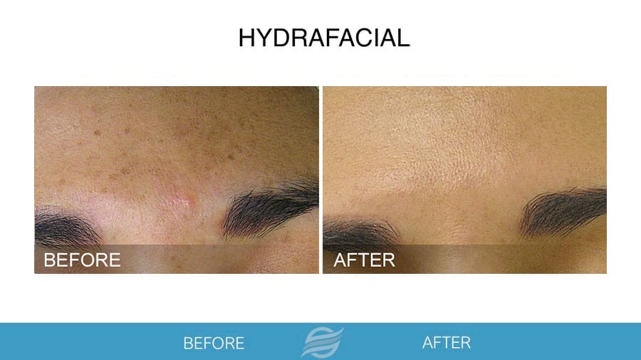 HydraFacial before and after result 1
