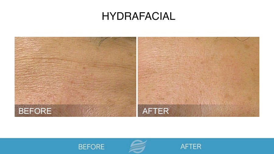 HydraFacial before and after result 2