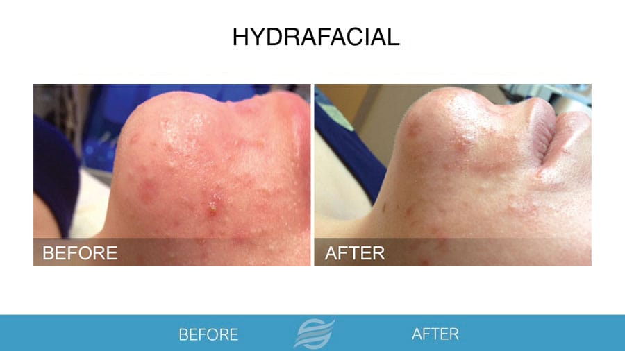HydraFacial before and after result 3
