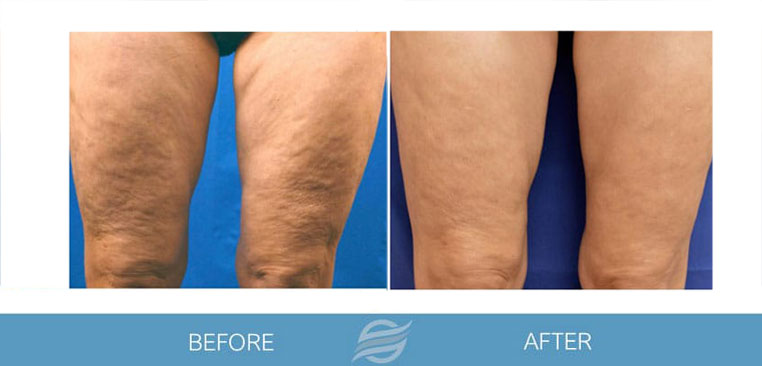 Microneedling before and after result 1