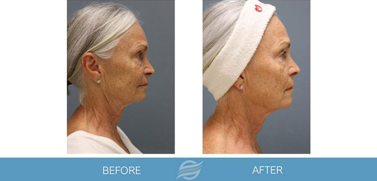Microneedling before and after result 2