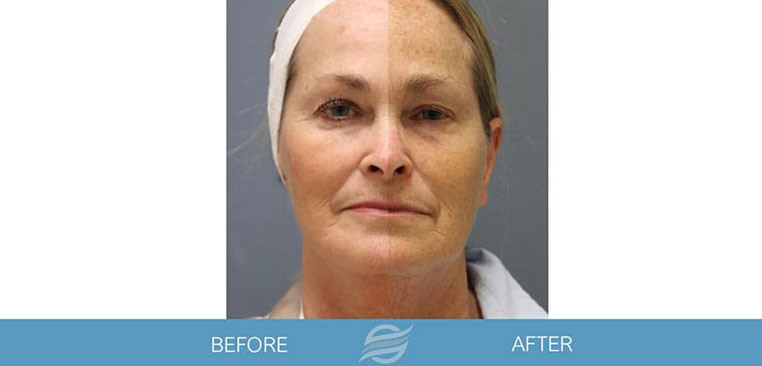 Microneedling before and after result 3