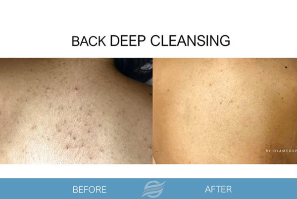 before and after back deep cleansing
