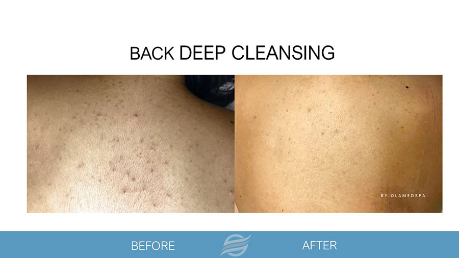 before and after back deep cleansing