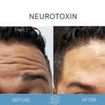 before and after neurotoxin