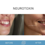 before and after neurotoxin