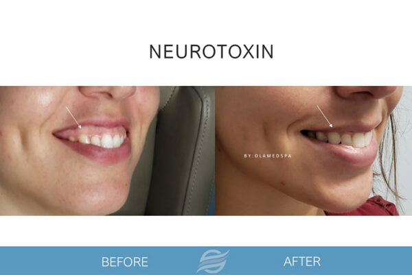 before and after neurotoxin