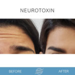 before and after neurotoxin