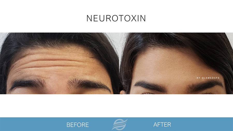before and after neurotoxin