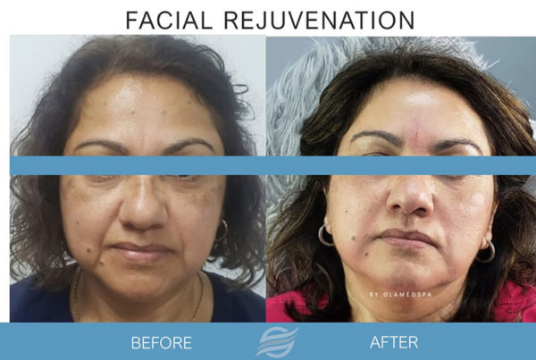 before and after facial rejuvenation
