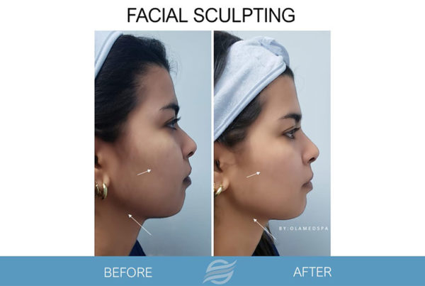 before and after facial sculpting
