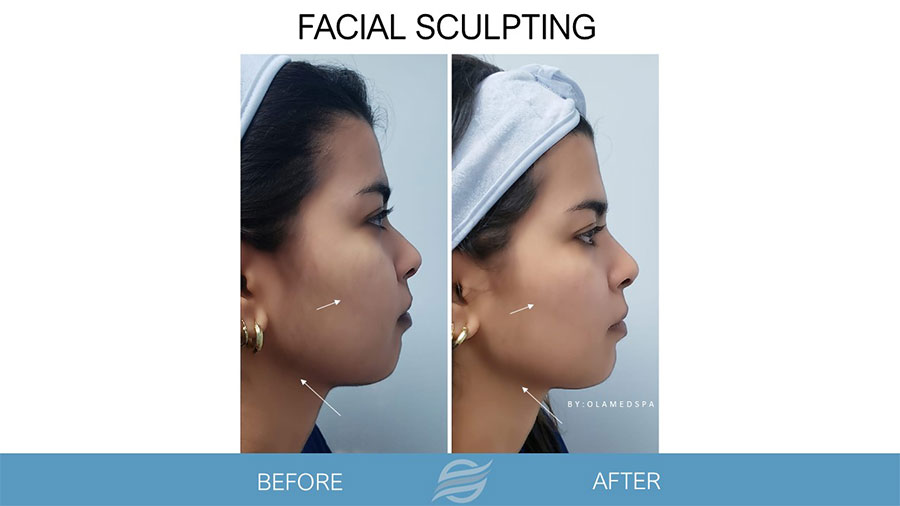 Facial Sculpting