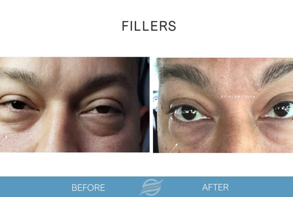 before and after fillers