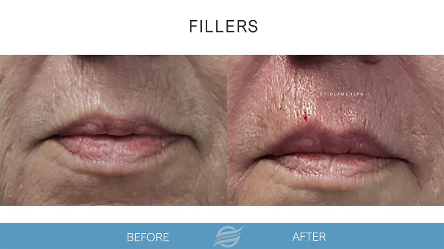before and after fillers