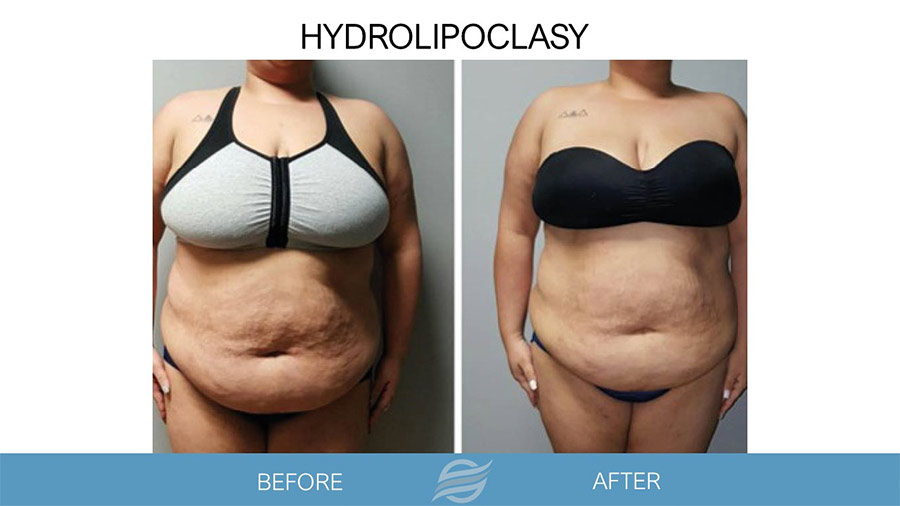 before and after hydrolipoclasy