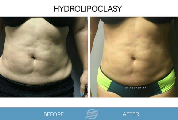 before and after hydrolipoclasy