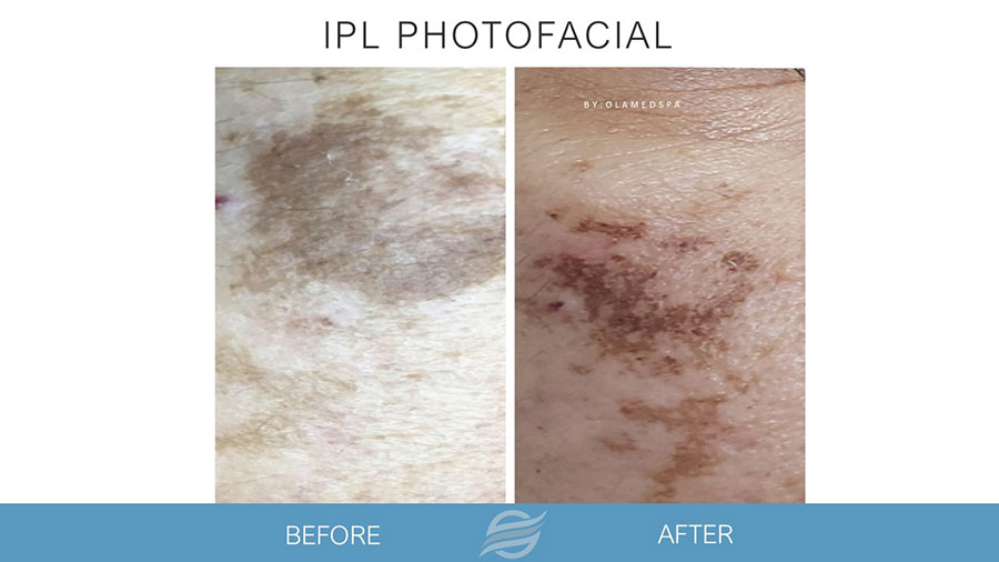 before and after ipl photofacial
