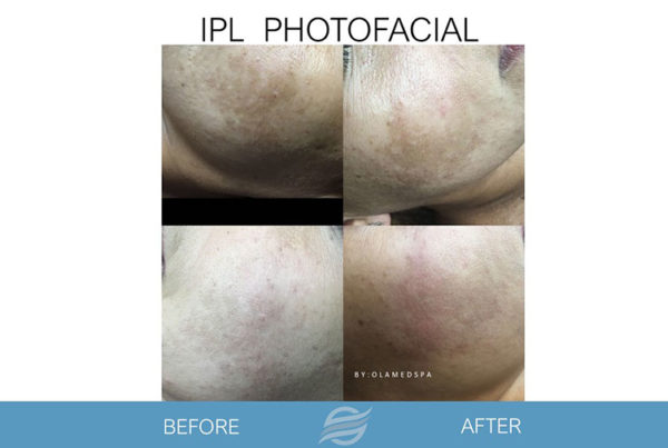 before and after ipl photofacial
