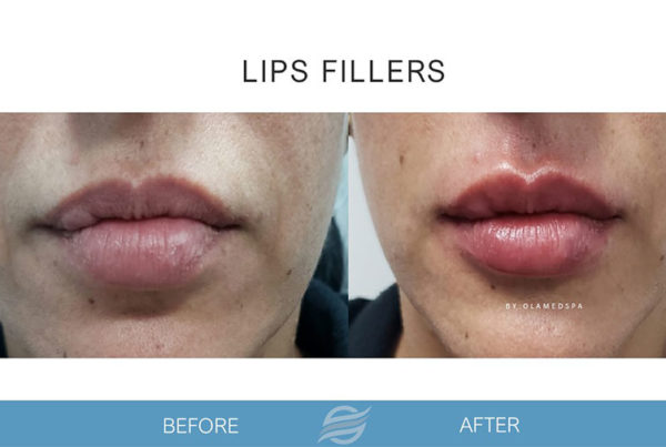 before and after lip fillers