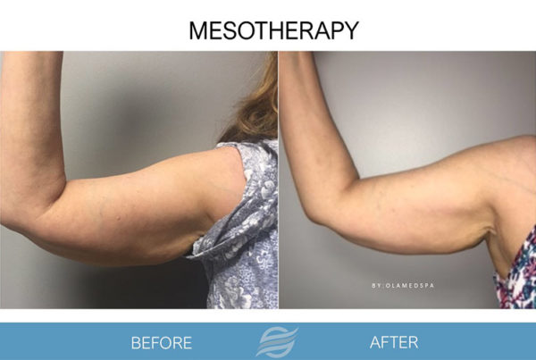 before and after mesotherapy