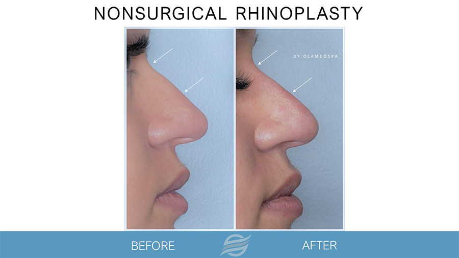before and after nonsurgical rhinoplasty