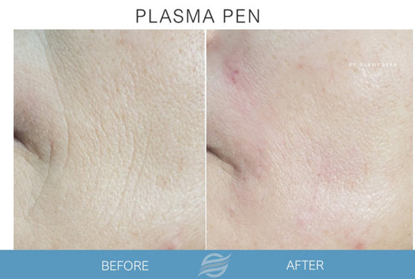 before and after plasma pen
