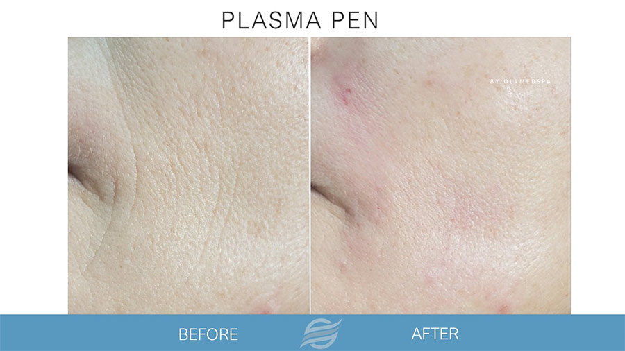 before and after plasma pen