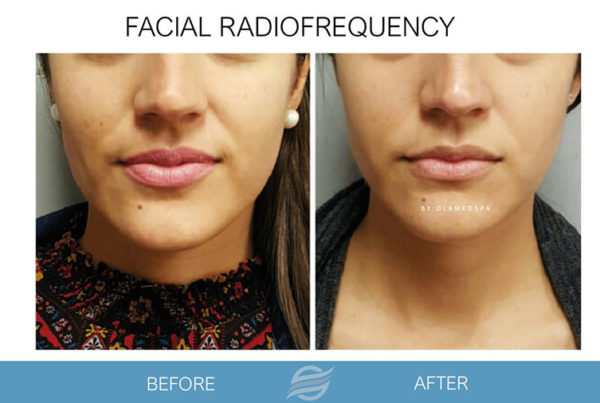 before and after facial radiofrequency