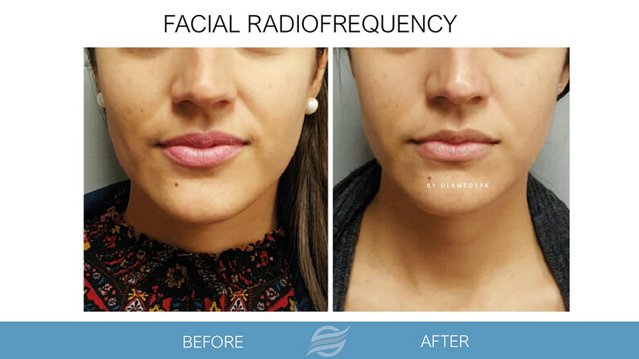 before and after facial radiofrequency