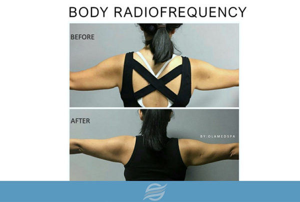 before and after body radiofrequency