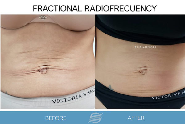 before and after fractional radiofrecuency