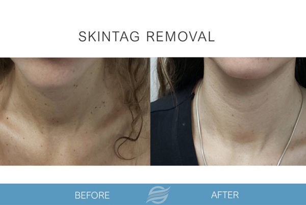before and after skintag removal