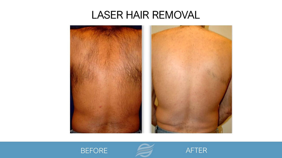 before and after laser hair removal