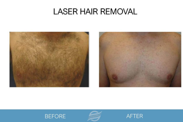 before and after laser hair removal