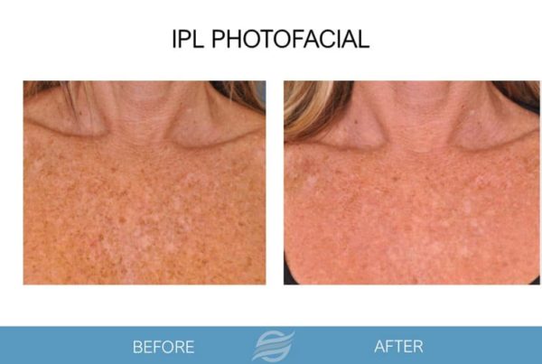 before and after ipl