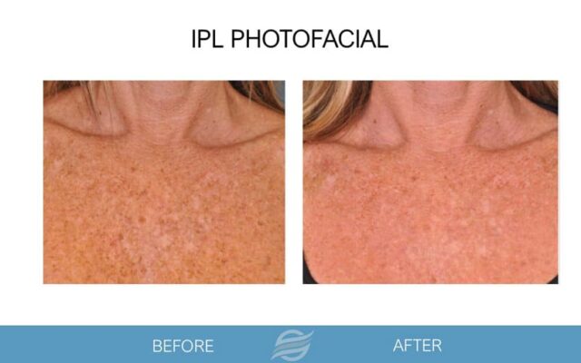 before and after ipl