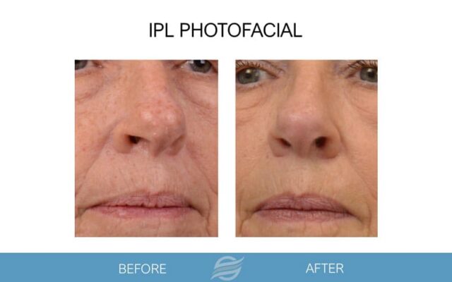 before and after ipl