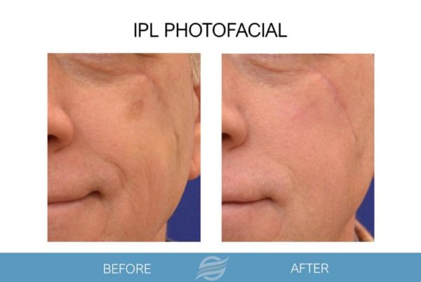before and after ipl