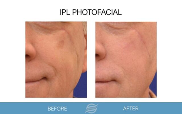before and after ipl