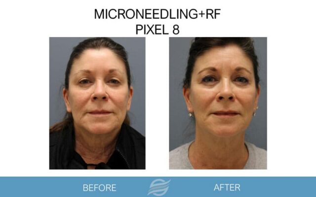 before and after mircroneedling rf pixel 8