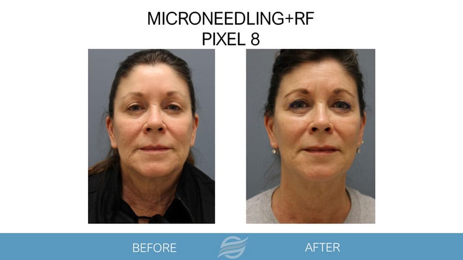 before and after mircroneedling rf pixel 8
