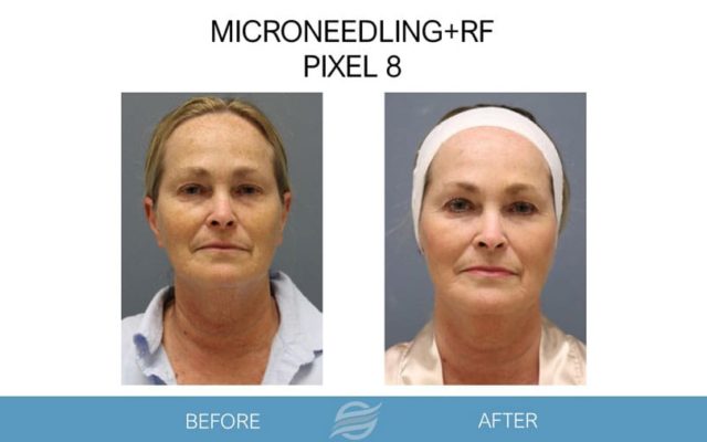 before and after mircroneedling rf pixel 8