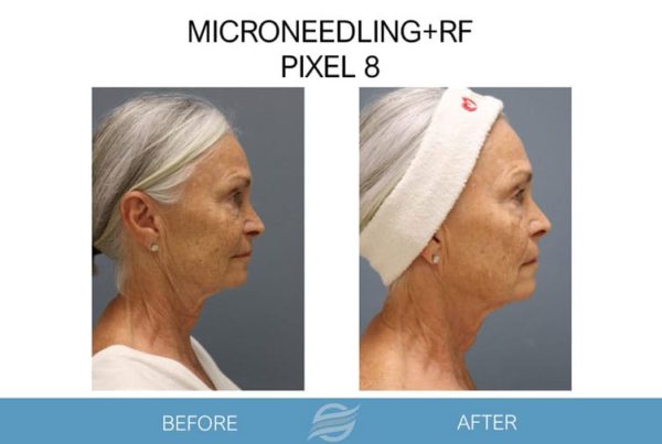 before and after mircroneedling rf pixel 8