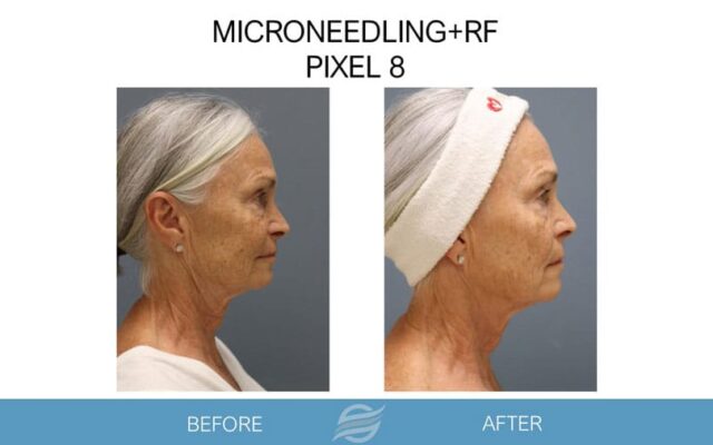 before and after mircroneedling rf pixel 8