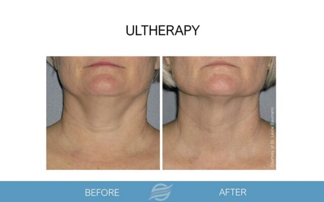 before and after ultherapy