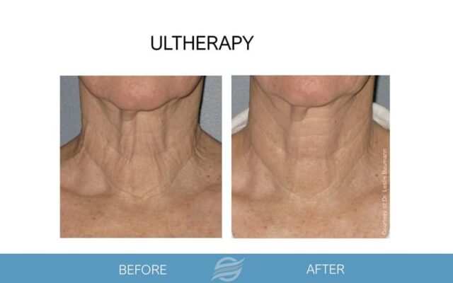 before and after ultherapy